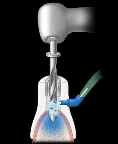 The IrriGuide adapter. Image courtesy of Smyles Above Innovations.