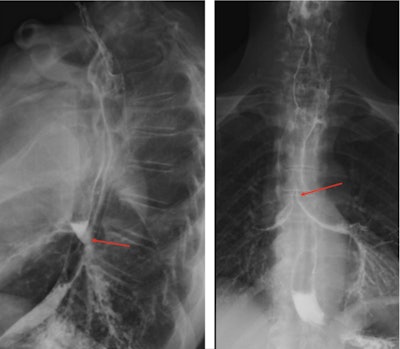 Preoperative barium swallow fluoroscopy study. Shows contrast in the trachea and esophagus (red arrows), suggesting a fistulous communication. Images and captions courtesy of Dr. Hannah Jesani, et al. Licensed under CC BY 4.0.