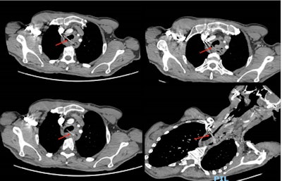 Axial slices of the computed tomography scan with contrast. Images show a linear hyperdense shadow extending from the esophagus to the proximal trachea within a tracheo-esophageal fistulous tract at the level of T2 vertebrae.