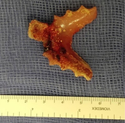 The extracted foreign body: a removable, partial denture.