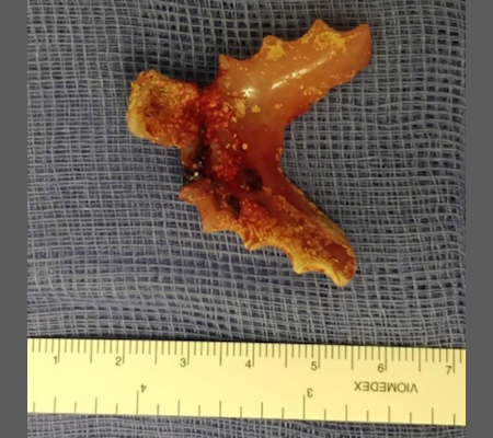 2024 11 12 Long Long Denture Fistula Fig3 400