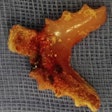 2024 11 12 Long Long Denture Fistula Fig3 400