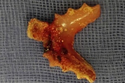 2024 11 12 Long Long Denture Fistula Fig3 400