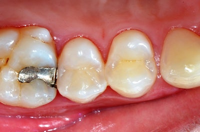 Postop photo of tooth #4.