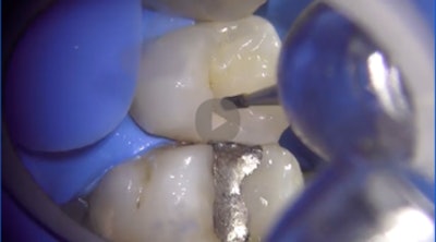 Preop screenshot of tooth #4. Images courtesy of Dr. Jorge F. Zapata.