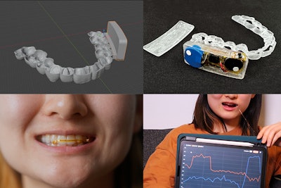 A dental brace developed by researchers at MIT CSAIL and Aarhus University can be fabricated with sensors and feedback components to capture in-mouth interactions and data. Images courtesy of Sebastian Krog Knudsen and the researchers/MIT.