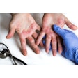 Atopic Dermatitis Rochu 2008