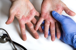 Atopic Dermatitis Rochu 2008