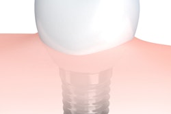 Dental Implant