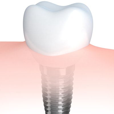 Dental Implant