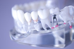 Dental Model Root Canal Edwardolive