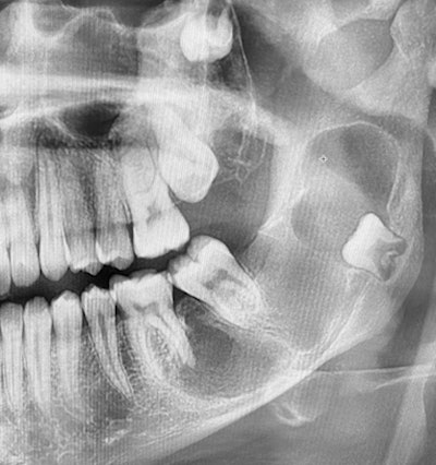16 Yo Girl Lesions Swelling 400