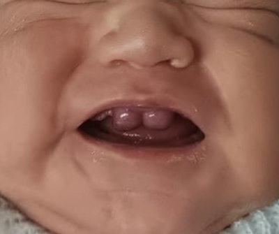 21 Do Boy Maxilla Bumps Fig1