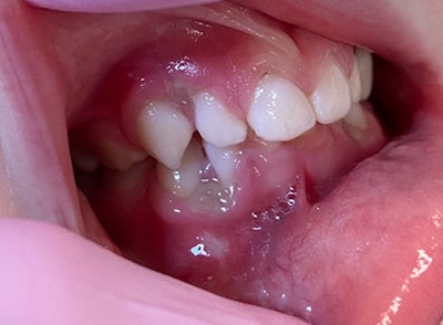 Fig 1 5 Yo Gingival Pain