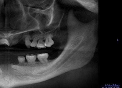 Fig 2 17 Yo Missing Teeth