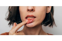 Gum Inflammation My Ocean Studio