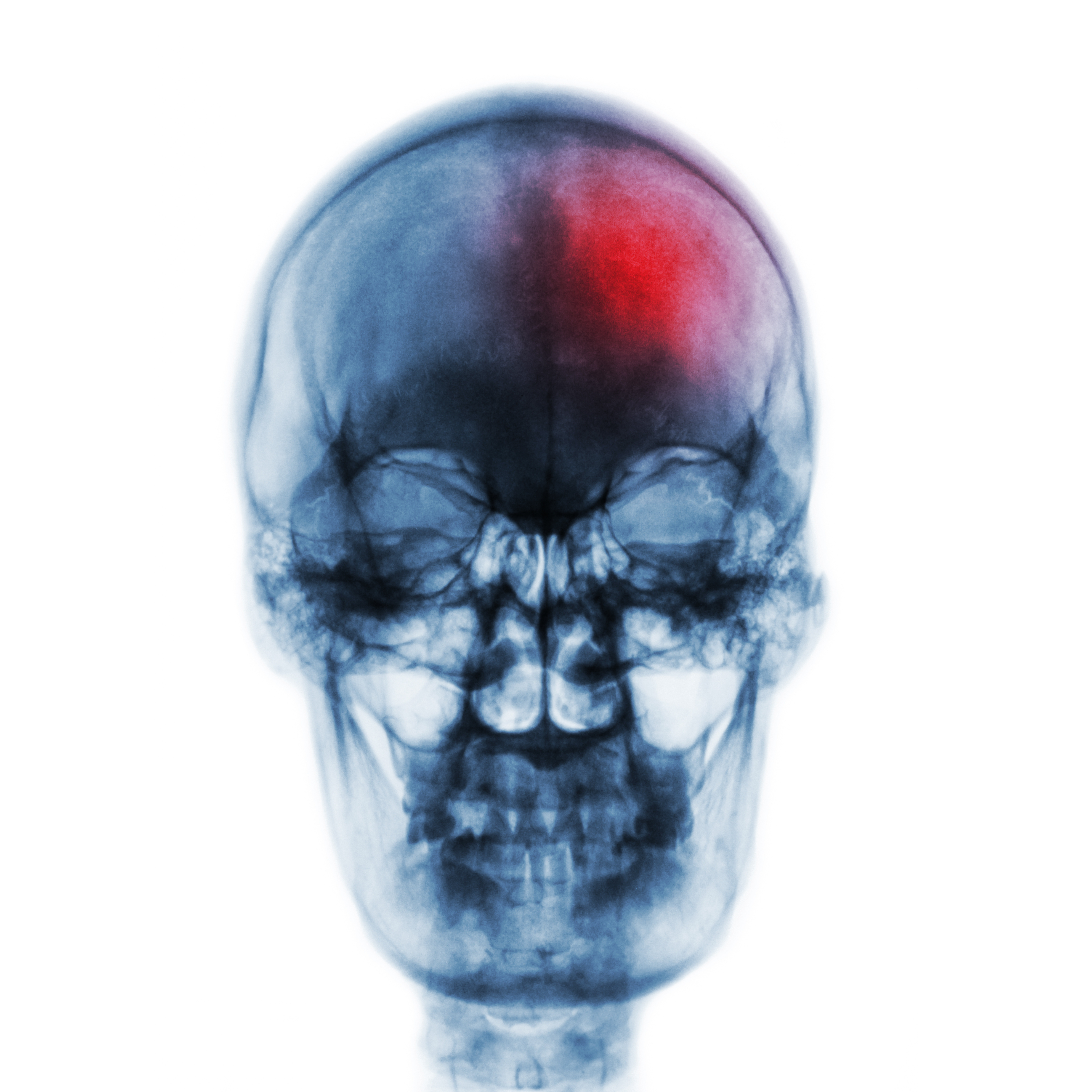Stroke Head Xray