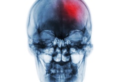 Stroke Head Xray