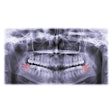 Third Molar Kabardins Photo