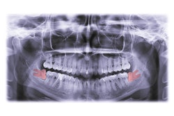 Third Molar Kabardins Photo