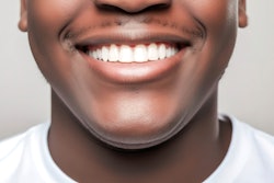 Veneers Man