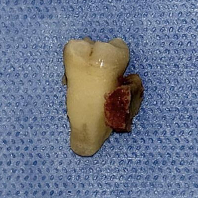 2025 01 28 Anesthesia Induce Osteonecrosis 400