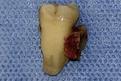 2025 01 28 Anesthesia Induce Osteonecrosis 400