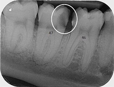 (d) Initial periapical radiograph of tooth 47 shows a cavity on the mesial side (white circle). Images and captions courtesy of Geusens et al. Licensed under CC BY-NC-ND 4.0.
