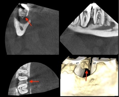 The CBCT revealed the presence of sequestered bone between tooth #46 and tooth #47 (red arrow). The sequester is shown in coronal, sagittal, and axial views as well as in a 3D reconstructed view.