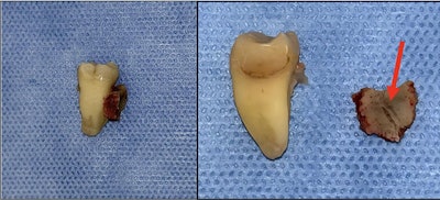 Necrotic interdental septum with trajectory of the needle clearly visible (red arrow).
