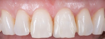 Figure 1: Pre-op photo of teeth #s 7-10 showing fractures caused by bruxism. Images and captions courtesy of Dr. Jae Seon Kim, MSD.