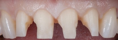 Figure 2: Initial reduction and preparation of teeth #s 7-10.