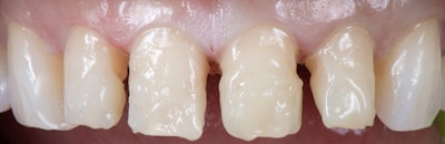 Figure 3: Composite build-up with Clearfil Majesty ES Flow Universal.