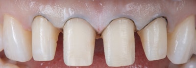 Figure 4: After composite build-up, preparations were refined and a retraction cord was placed.