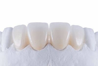 Figure 5: Finished Amber Press lithium disilicate crowns on a model.