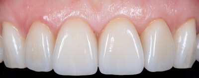 Figure 6: Close-up of seated final restorations.
