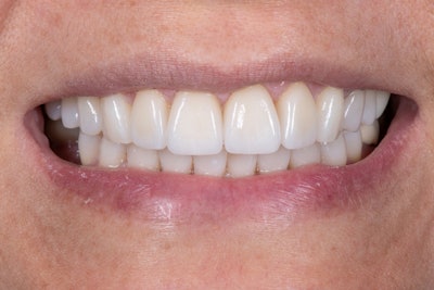 Figure 7: Full-smile view of seated final restorations.