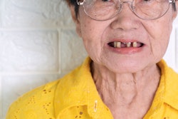 Missing Teeth Woman