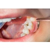 Tooth Caries Cavity