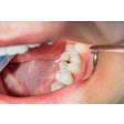 Tooth Caries Cavity