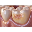 Tooth Decay Olya