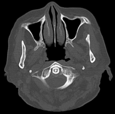 Plain CT scan showing calcification surrounding the odontoid process. An axial CT scan of the cervical spine shows calcification on the posterior aspect of the odontoid process.