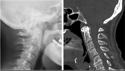 Comparison of a cervical sagittal radiograph and CT scan. Calcification around the odontoid process is not visible on a radiograph. Images courtesy of Mosuda et al. Licensed under CC BY-NC-ND 4.0.