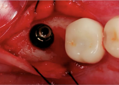 2025 02 26 Cdocs Bone Profiling 400