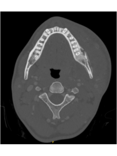 2025 02 27 Lemierre's Syndrome 400