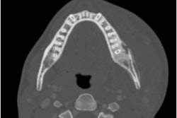 2025 02 27 Lemierre's Syndrome 400