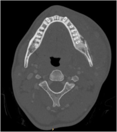 Axial CT scan demonstrating severe left hemimandible osteomyelitis with medullary and cortical osteolytic destruction and sclerosis with small abscesses on the buccal side of the mandible. Evidence of left masseter myositis and significant swelling of the masticator and left lingual space. Images courtesy of Podolsky et al. Licensed under CC BY-NC-ND 4.0.