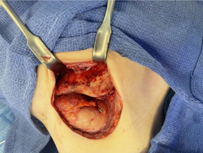 Intraoperative view through the left Risdon approach demonstrating cortical erosion and scleroses of the buccal plate of the left mandibular body, angle, and ramus prior to debridement.