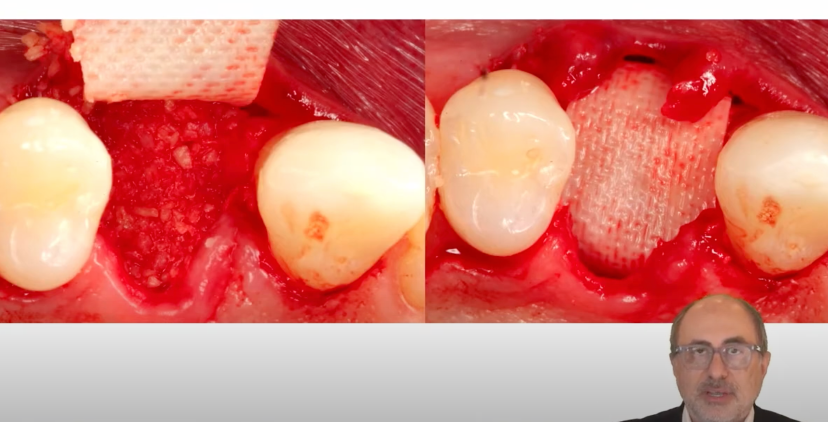 Dr. Farhad Boltchi explains the double membrane socket graft.