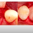 Dr. Farhad Boltchi explains the double membrane socket graft.